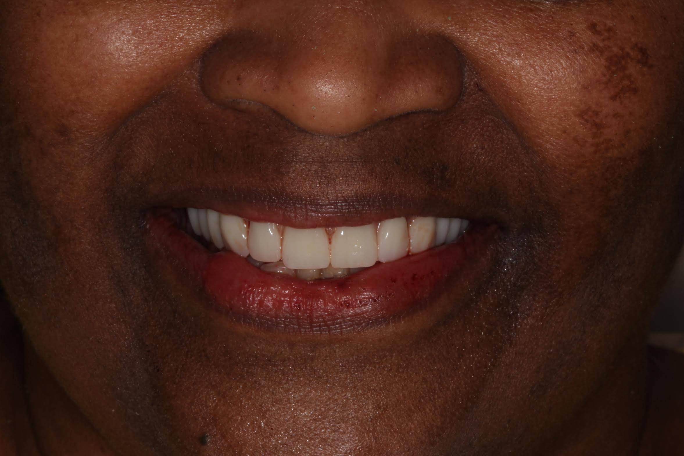Frankie — after full-arch dental implant restoration in Hollister