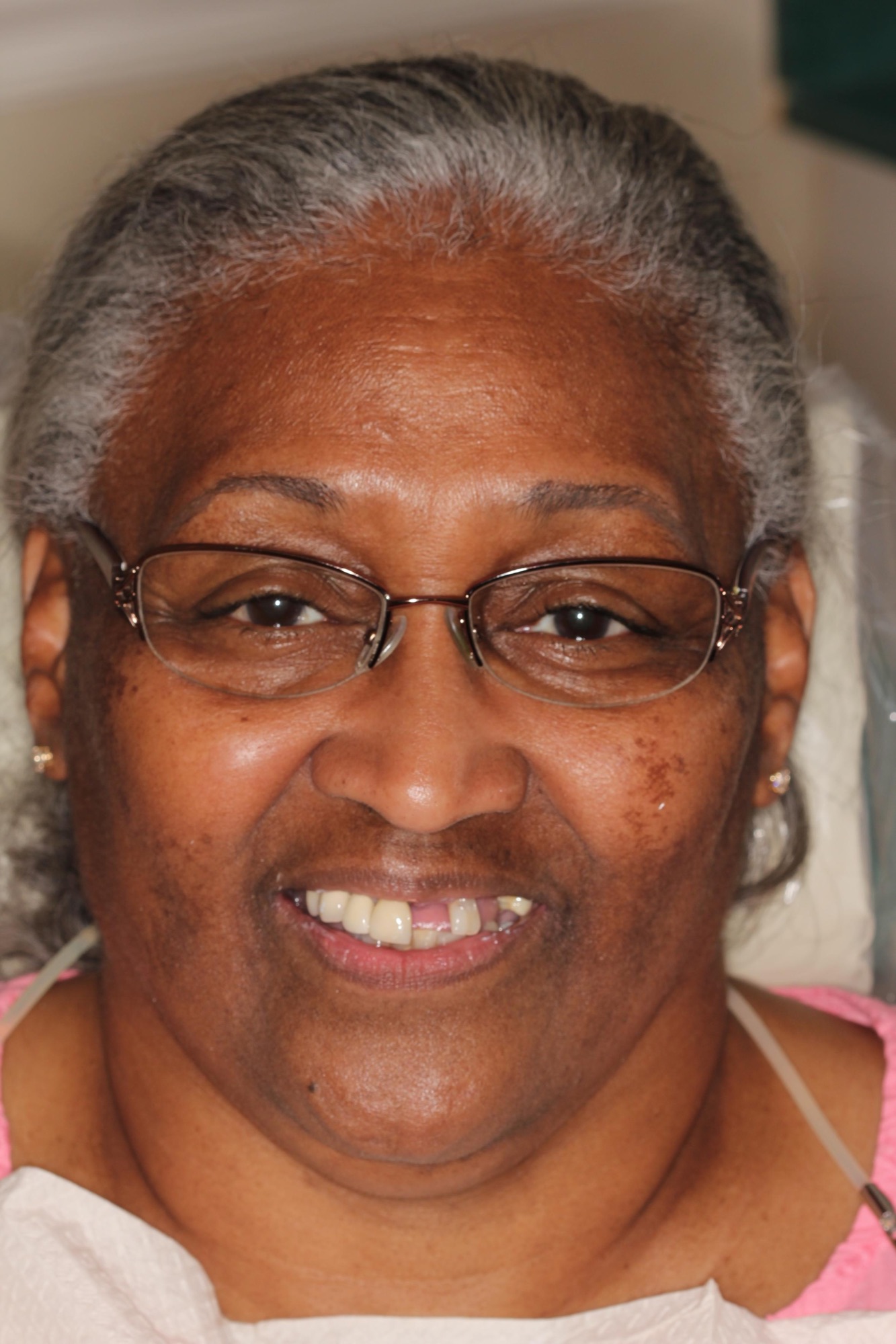Frankie — before full-arch dental implant restoration in Hollister
