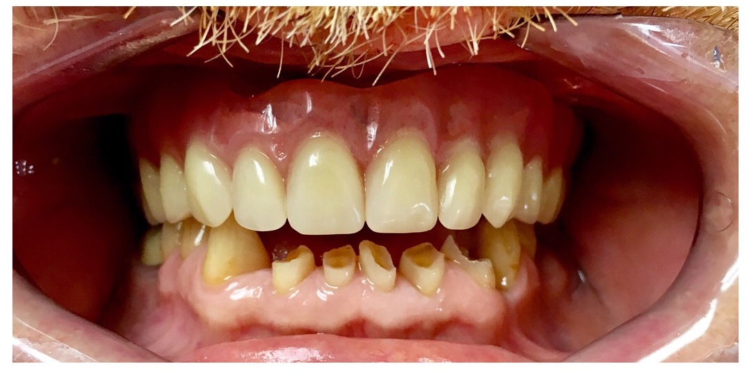 Restored upper arch with implant-supported teeth — after Dr. Rauch's treatment