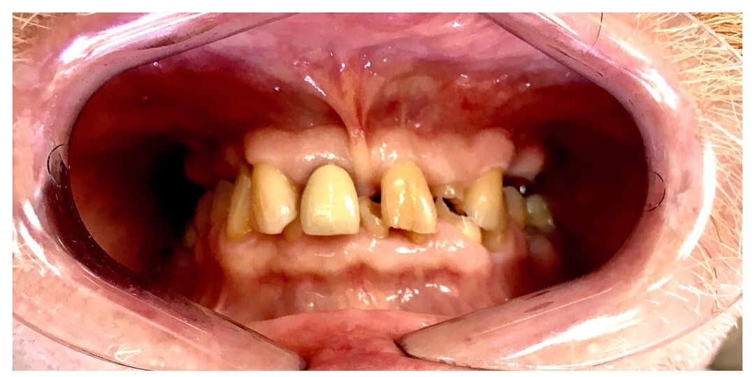Severely worn dentition — before full-arch implant restoration