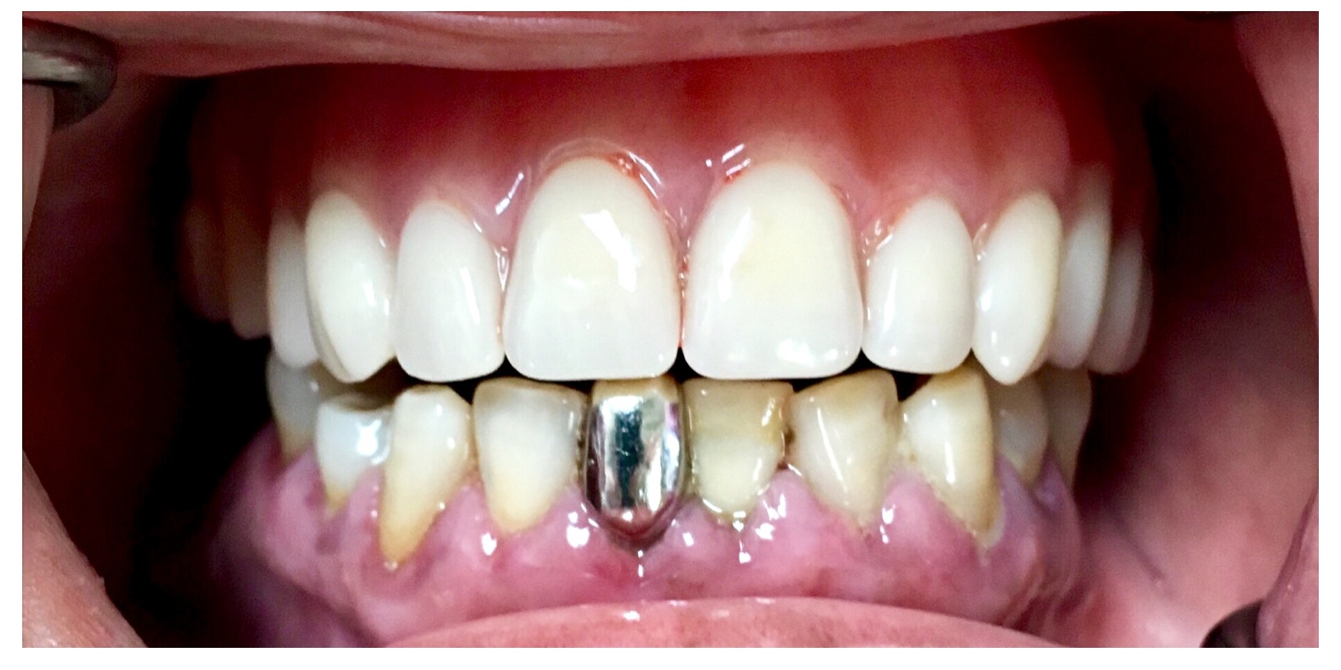Restored smile after implant and cosmetic work by Dr. Rauch