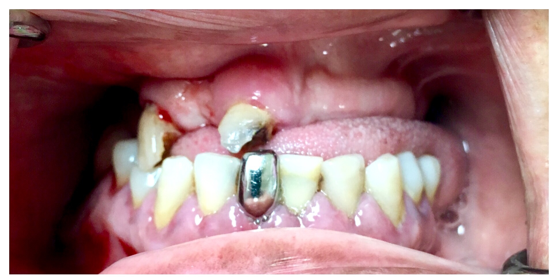 Failing front teeth — before implant + cosmetic restoration
