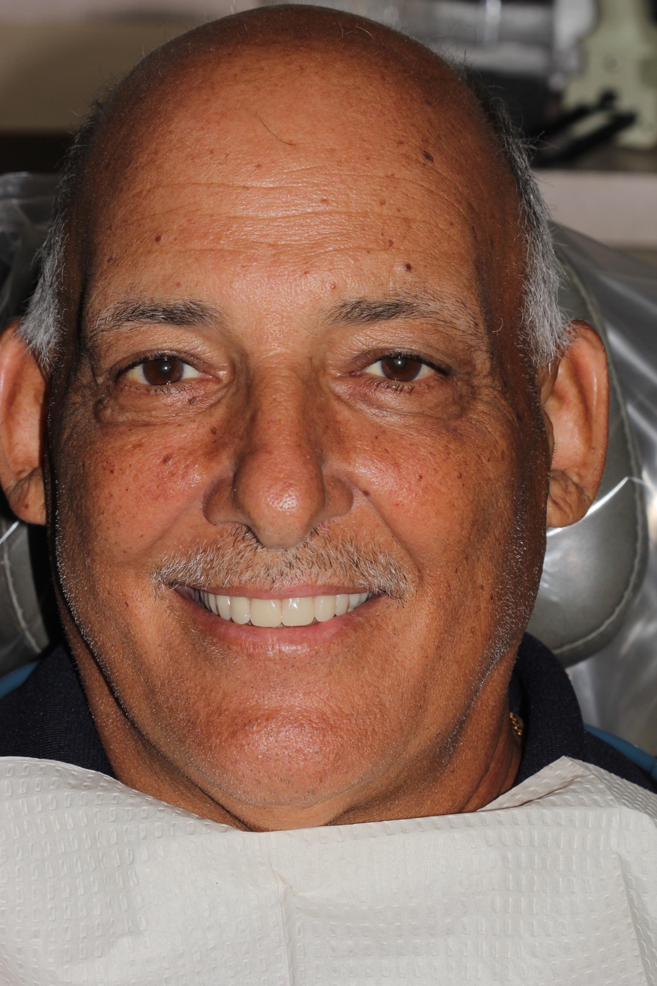 John — after All-on-4 dental implant treatment in Hollister