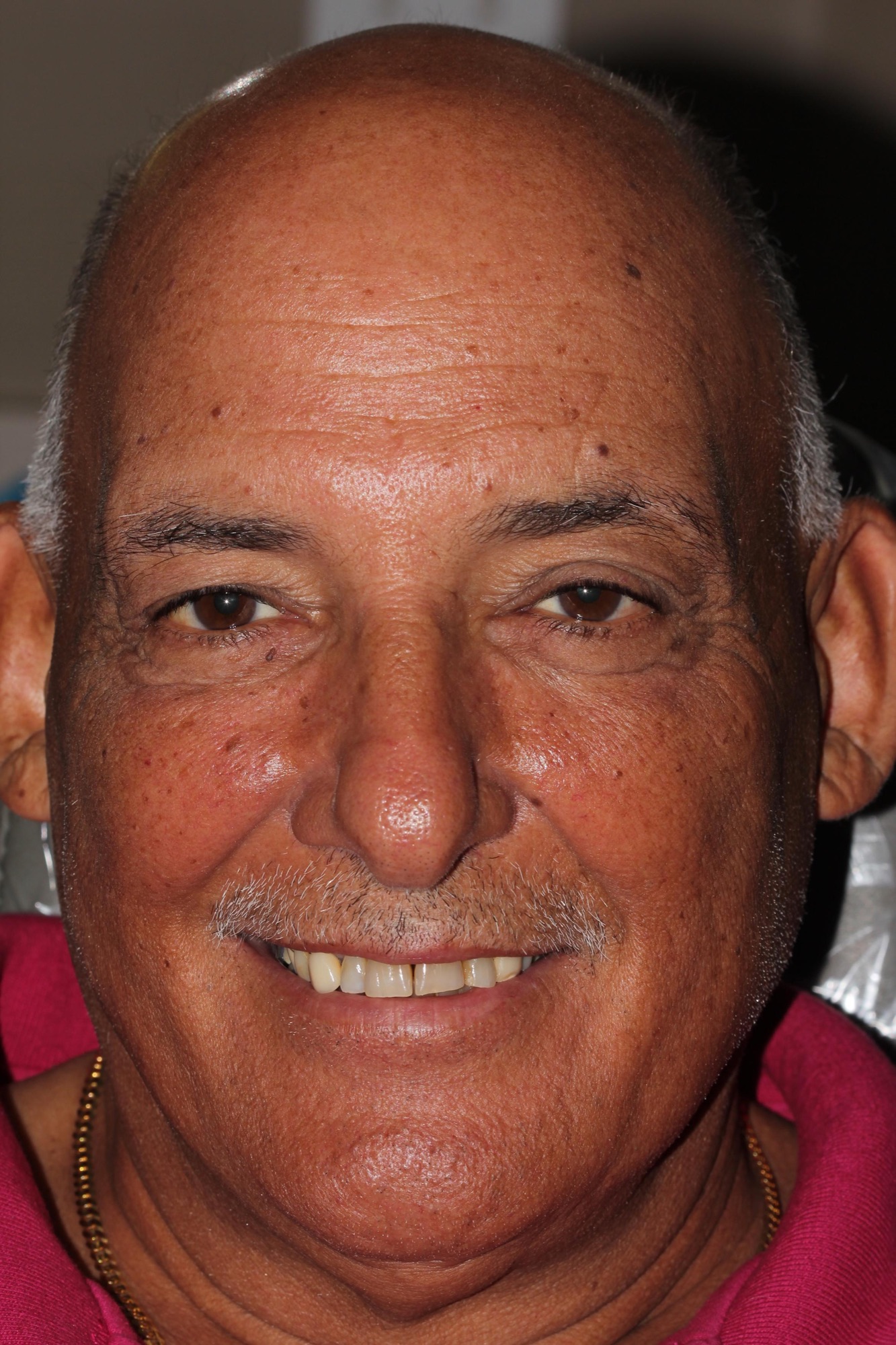 John — before All-on-4 dental implant treatment with Dr. Rauch in Hollister