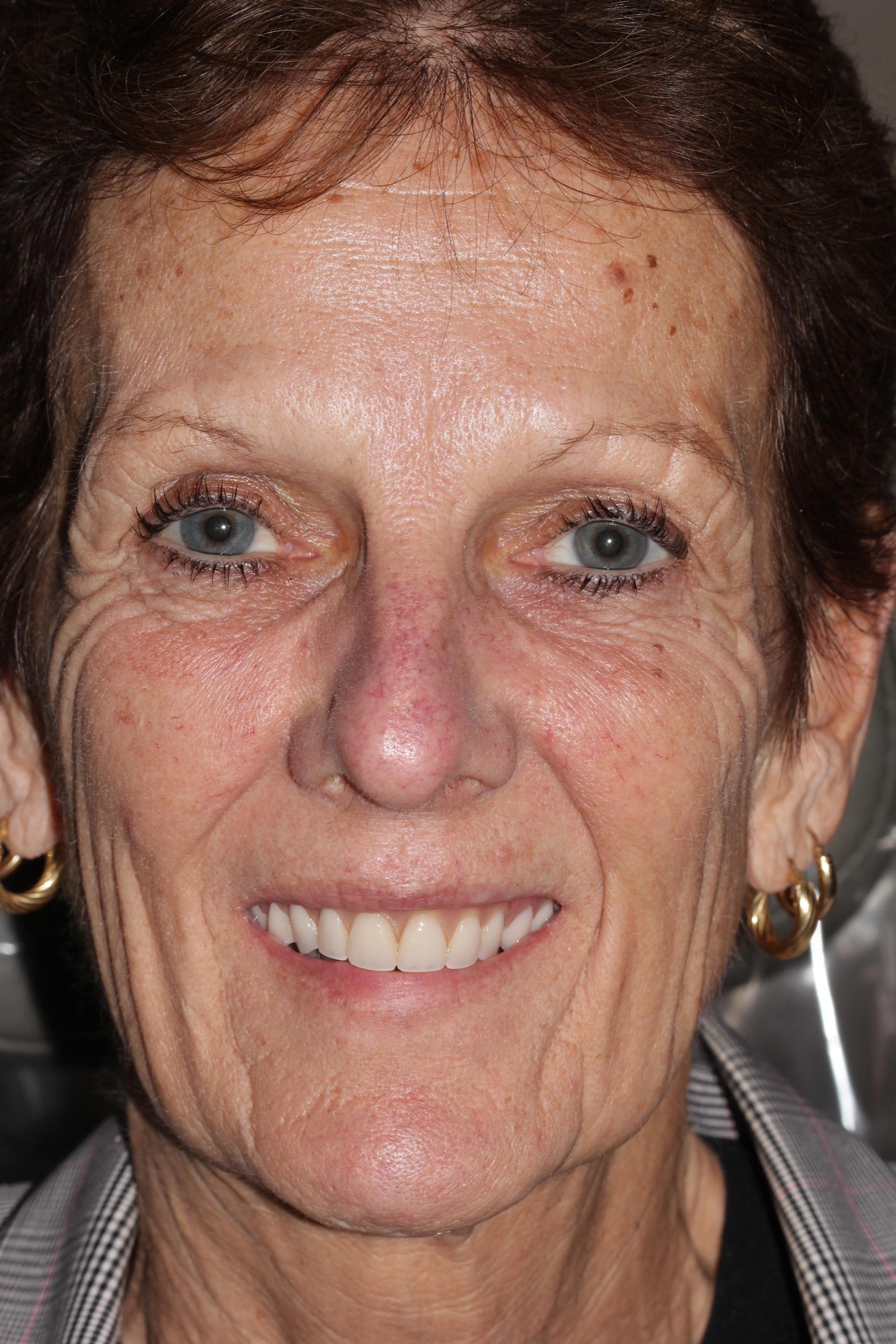 Ruth — after full-arch dental implant restoration in Hollister