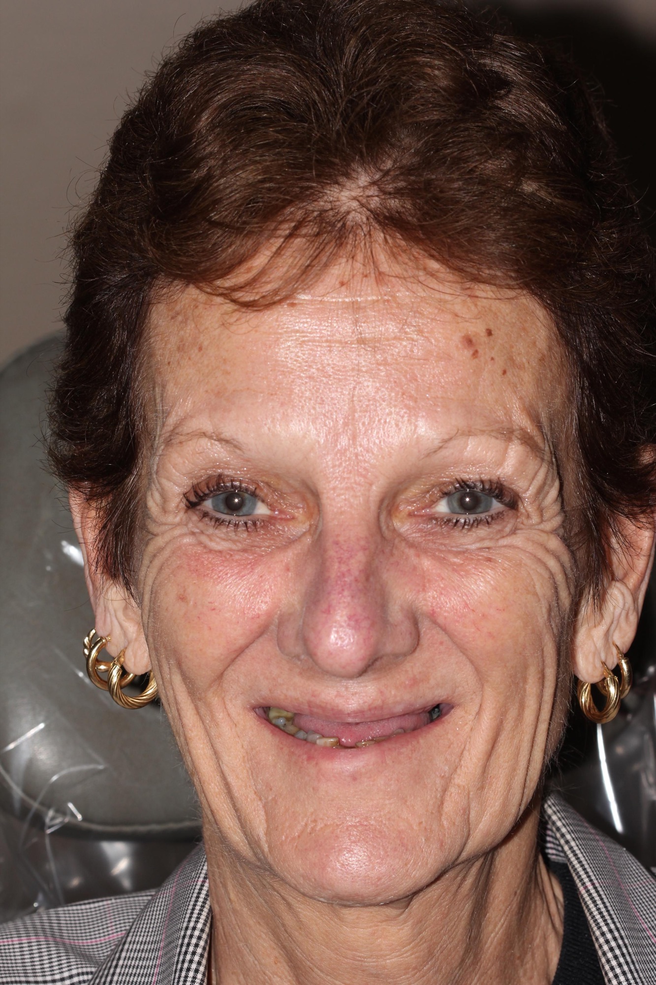 Ruth — before full-arch dental implant restoration in Hollister