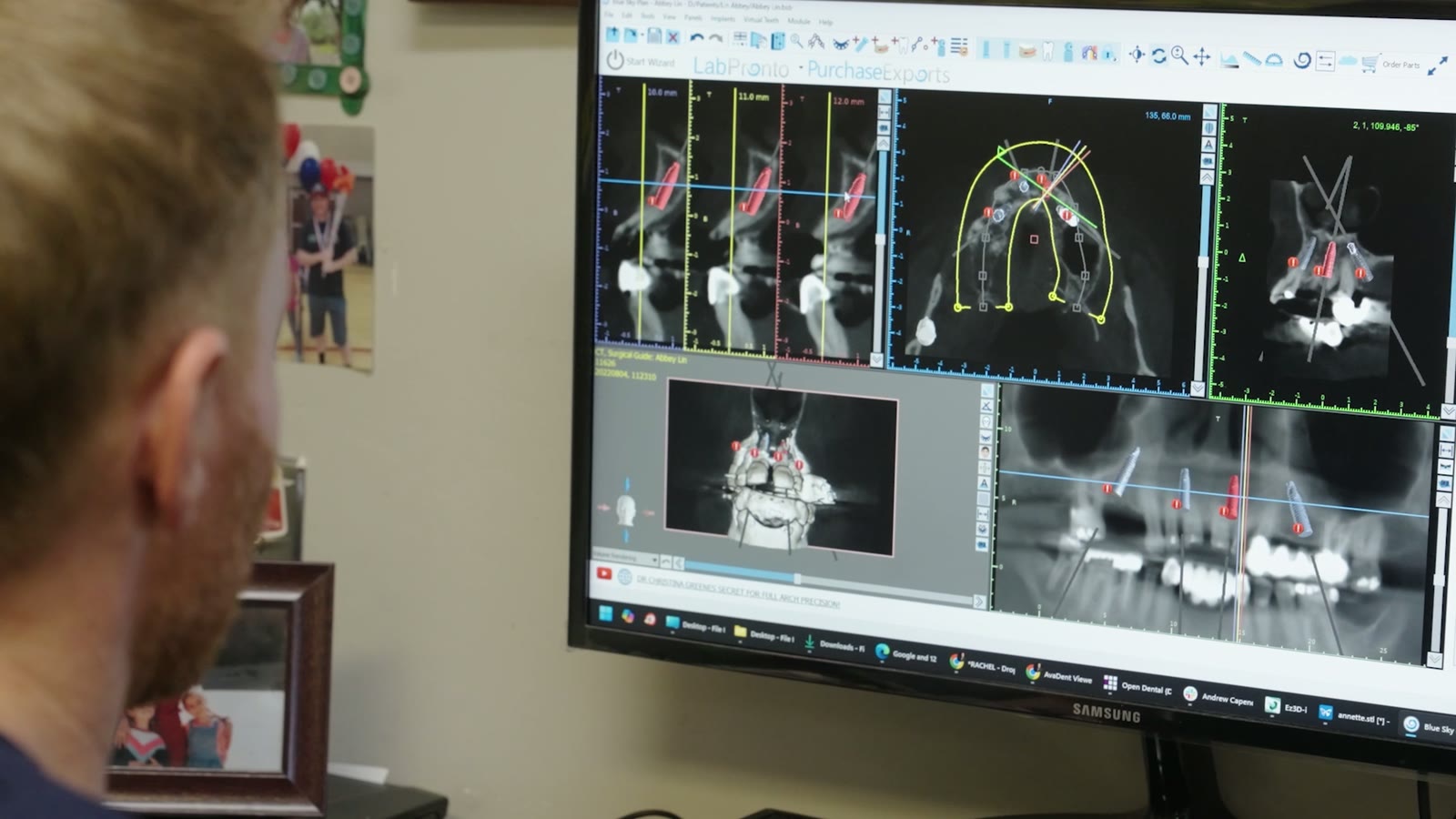 Dr. Rauch reviewing a 3D CBCT scan to plan implant placement in Hollister, CA